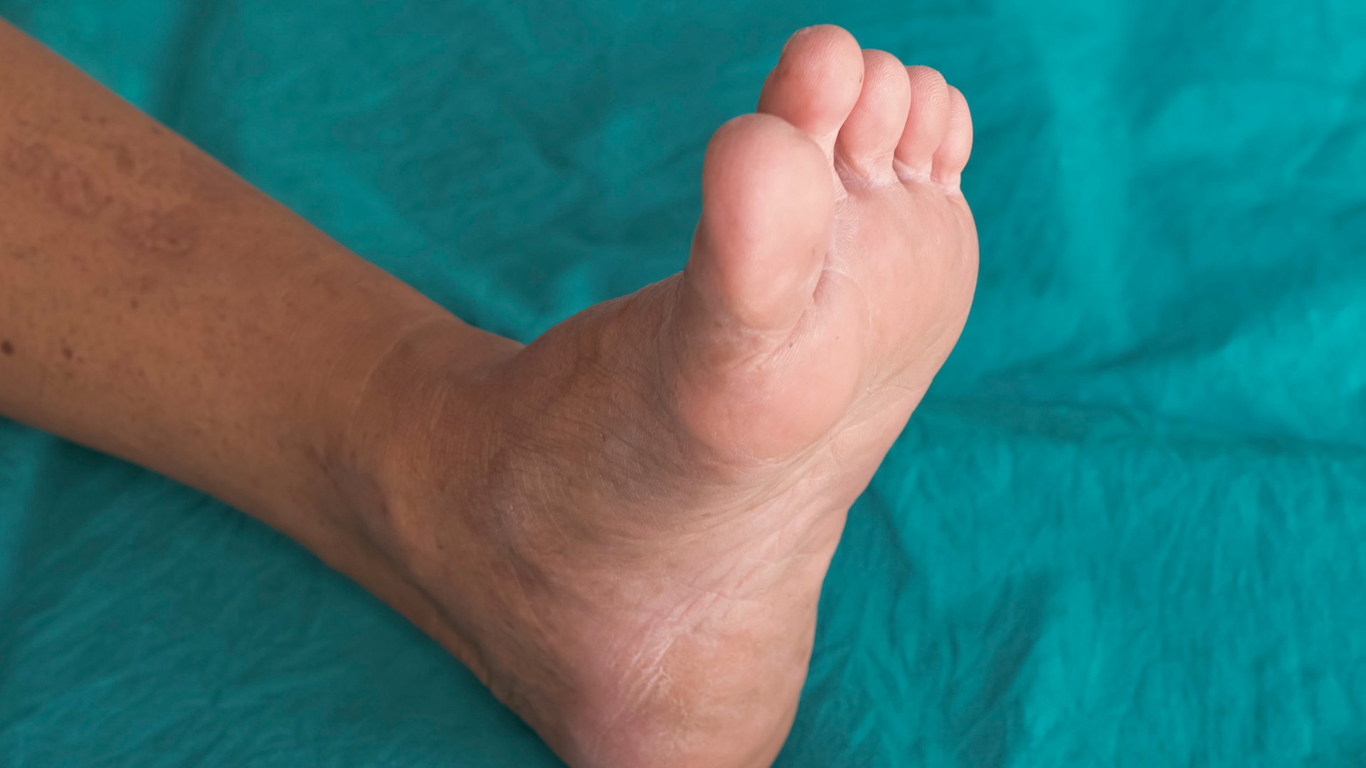 cukorbeteg láb cikk.png